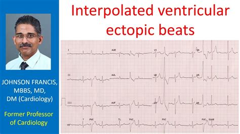 Interpolated Ventricular Ectopic Beats Youtube