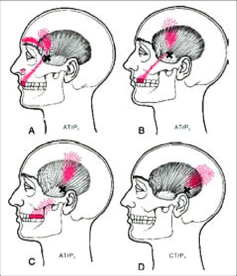 Referred Pain From The Jaw Premier Sports Medicine