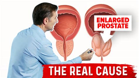 Enlarged Prostate And Urination Problems New Data Healthy Keto Dr Berg