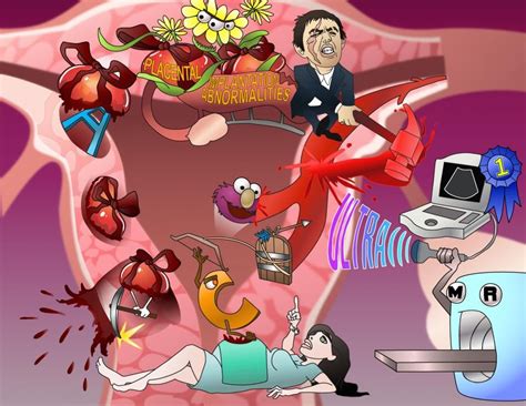 Postpartum Hemorrhage Clinical Practice Osmosis