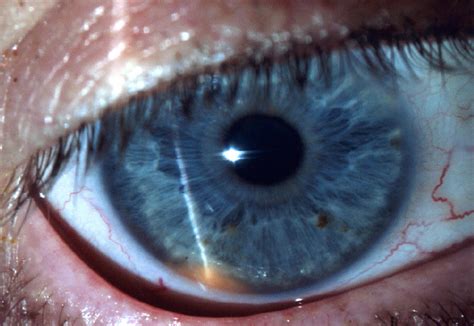 Iris Ciliary Body Melanoma Ophthalmology The