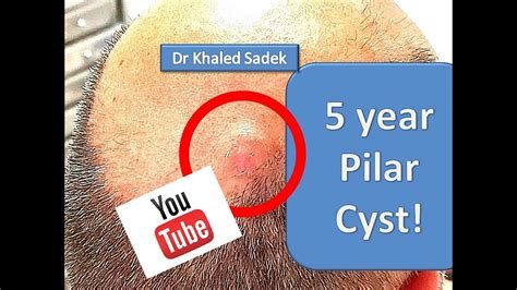 Year Face Cyst Cyst Removal Clinic London Dr Khaled Sadek Pimple My