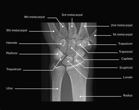 Left Wrist Normal Bone Structure