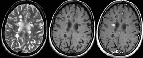 Depending on where the nerve damage occurs, ms can affect vision, sensation. Resonancia magnética, la esperanza del paciente con ...