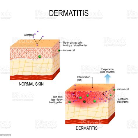 Atopic Dermatitis Stock Illustration Download Image Now Istock