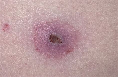 Skin Cancer Symptoms Nhs Can You Spot The Cancerous Mole Cancerous