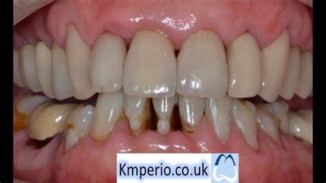 Treat Periodontal Gum Disease Before Aesthetic Dentistry YouTube