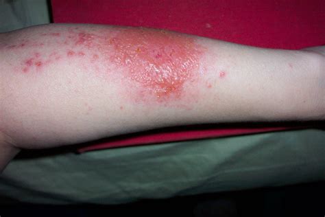 Skin Rash Dermatitis Eczema Or Hives Clipart Free Download Clip