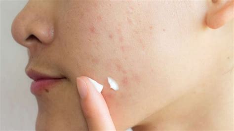5 Easy Way To Get Rid Of Acne Scars In Teenagers Ourahealth