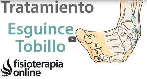 Esguince De Tobillo Tratamiento Guía Muy Completa Fisioterapia