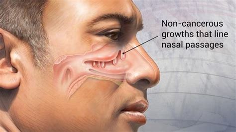 Nasal Polyp Types Causes Symptoms And Treatments Coimbatore