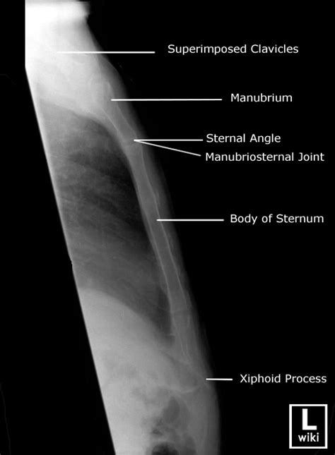 Sternum Radiographic Anatomy Wikiradiography