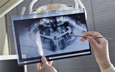 What To Expect At Your First Dental Implant Consultation 3stepsmiles