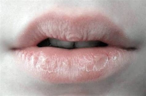 Can Too Much Kissing Cause Chapped Lips