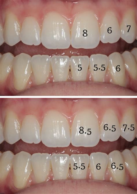 Improve Smile Design With An Easy Tooth Width Proportion Formula