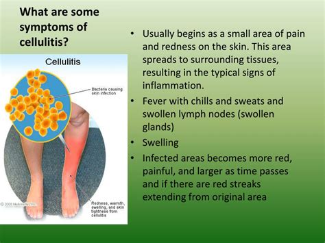 What Is Cellulitis Definition Causes Symptoms Treatme