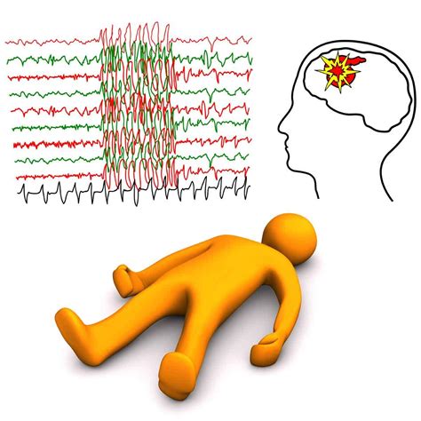 Further testing will help doctors confirm suspected seizures or find another condition. Triggers of Seizures | Epilepsy Foundation