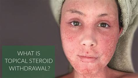 Topical Steroid Withdrawal