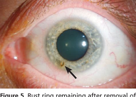 Figure From Management Of Corneal Abrasions Semantic Scholar