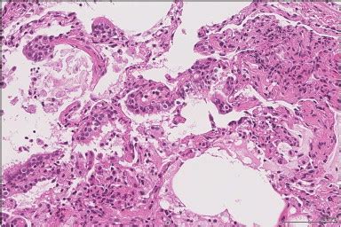 Transbronchial Lung Biopsy Specimen Shows Alveolar Wall Thickness With