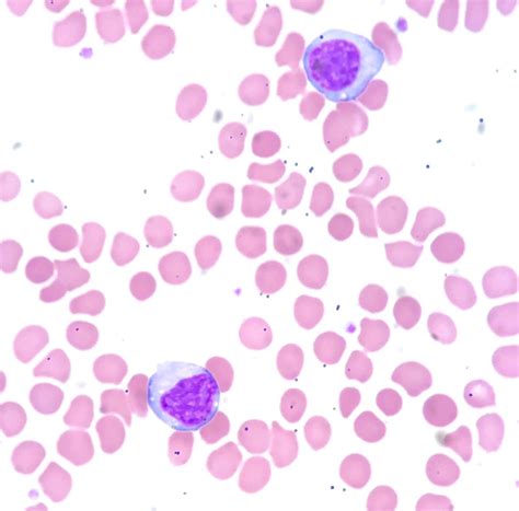 Reactive Lymphocytes In Peripheral Blood Infectious Mononucleosis A