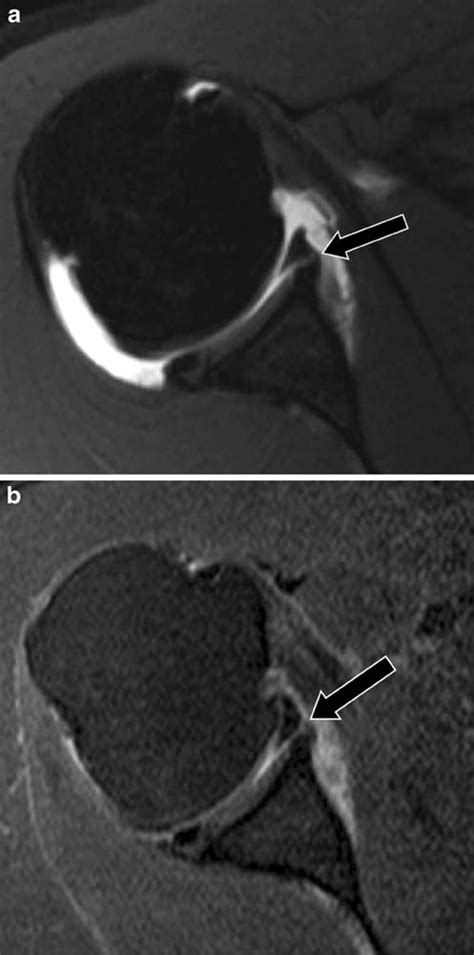 Mri Arthrogram Glenoid Labral Tear Medical Imaging Radiology Mri My