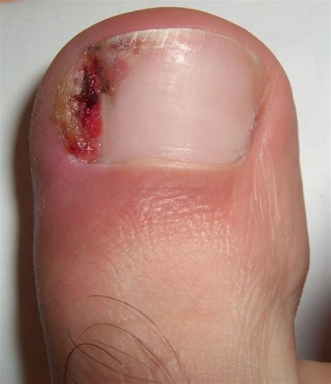 Infected Toenail After Removal