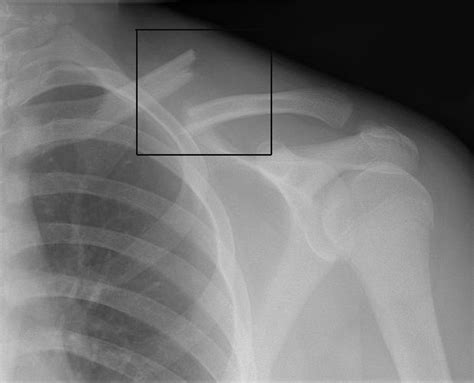Clinical Anatomy Of Clavicle Medchrome