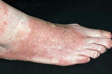 Infected Eczema On The Foot Photograph By Dr P Marazziscience Photo