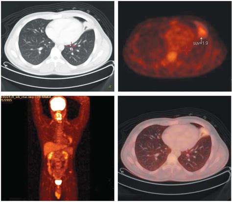 A Case Of Lung Carcinoid Tumor Successfully Treated With Bronchoscopic
