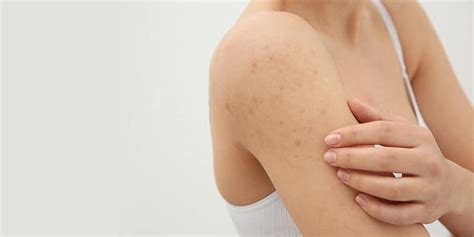 How To Get Rid Of Shoulder Acne We Are The Seen