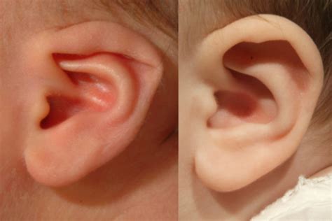 Folded Ear In Newborns Treatment Options Los Angeles Ent Doctors Ent