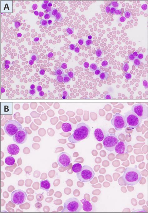 Ab Marked Leukocytosis With Large Sized Neoplastic Cells With Round To