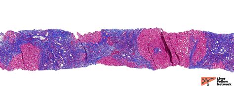 Liver Biopsy Interpretation: Special Stains | AASLD