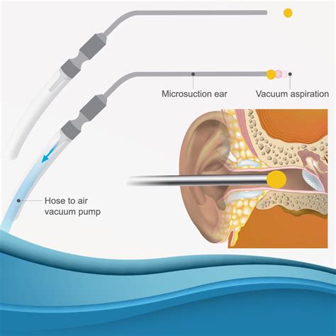Clinically Proven Ear Wax Removal Why Microsuction Wins Crystal
