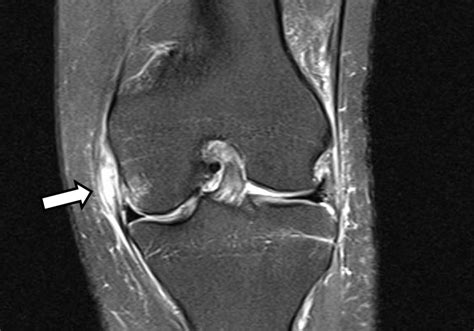 The Knee Resource Medial Knee Injury Medial Collateral Ligament