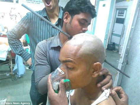 Mumbai Construction Workers Brain Is Pierced By Seven Foot Long Iron
