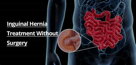 Inguinal Hernia Treatment Without Surgery Diet Plan And Gut Health