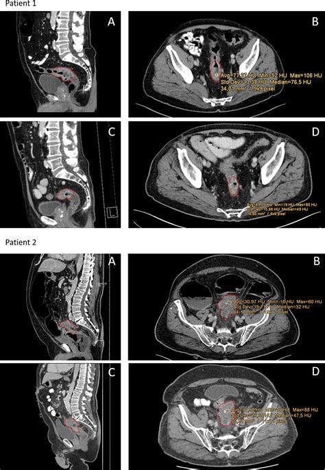frontiers computertomography based prediction of complete response following neoadjuvant