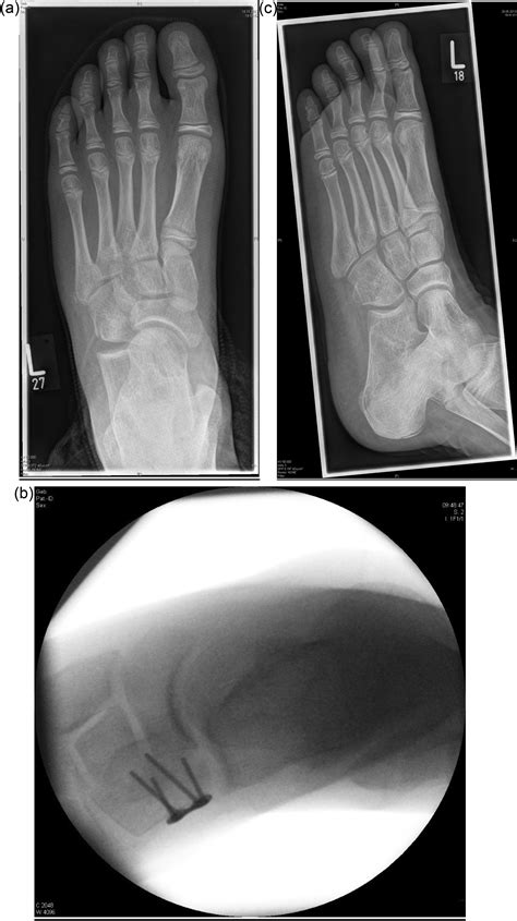 Cuboid Nutcracker Fracture In Children Management And Results Injury