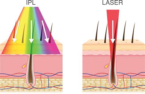 What Is The Best Laser For Hair Removal Use The One Thats Right For You