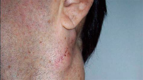 Lump Below Left Ear Lobe Ovulation Symptoms