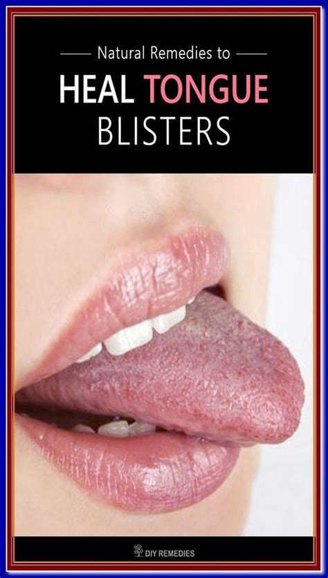 Blister On Tongue Artofit