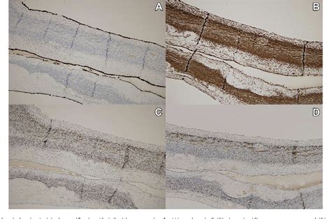 Figure 1 From Multilocular Cystic Nephroma A Case Report And Review Of