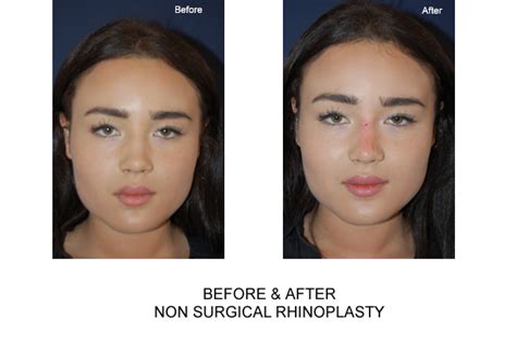 Non Surgical Nose Job Rhinoplasty In London 111 Harley St