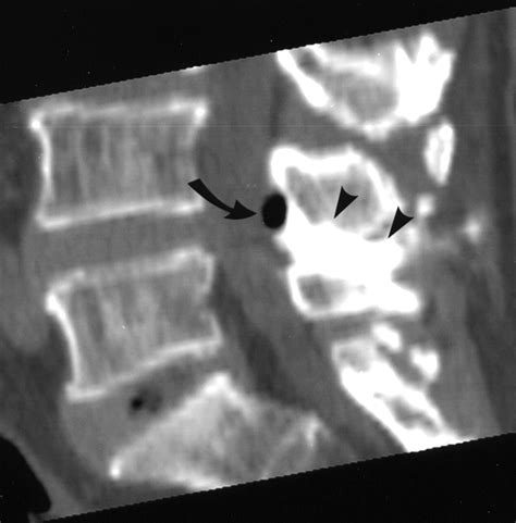intraspinal posterior epidural cysts associated with baastrup s disease