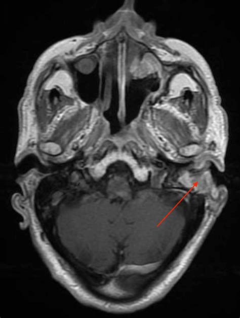 Cureus Inverted Sinonasal Papilloma Involving The Middle Ear With