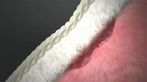 A zone i flexor tendon injury. EVARREST Fibrin Sealant Patch & the Mechanism of Action ...