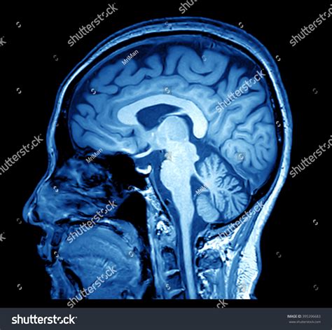 Magnetic Resonance Image Mri Of The Brain Stock Photo 395396683