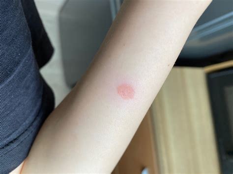 Появилось одно красное пятно на руке Вопрос дерматологу 03 Онлайн